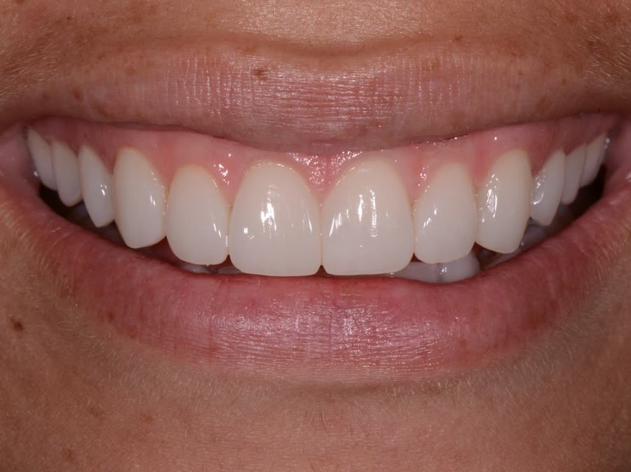 Case 4 — after