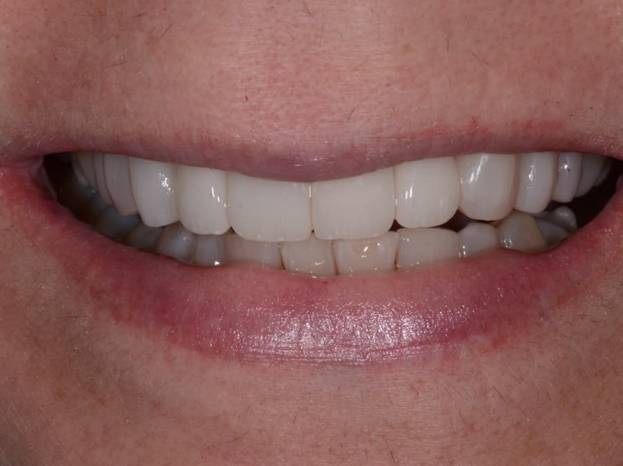 Case 11 — after